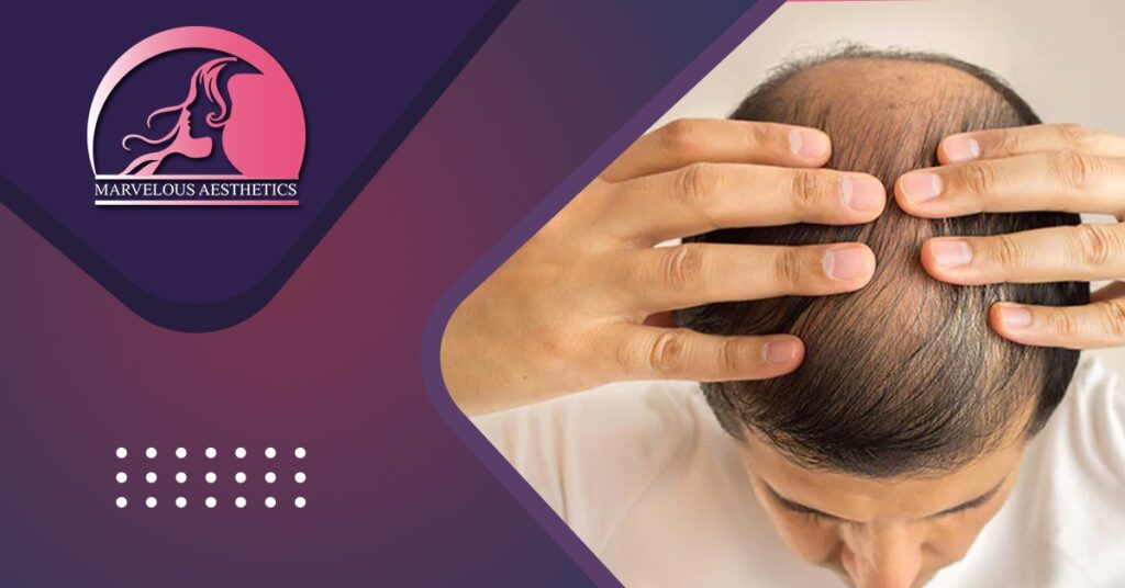 How To Get Best Treatment For Hair Loss?