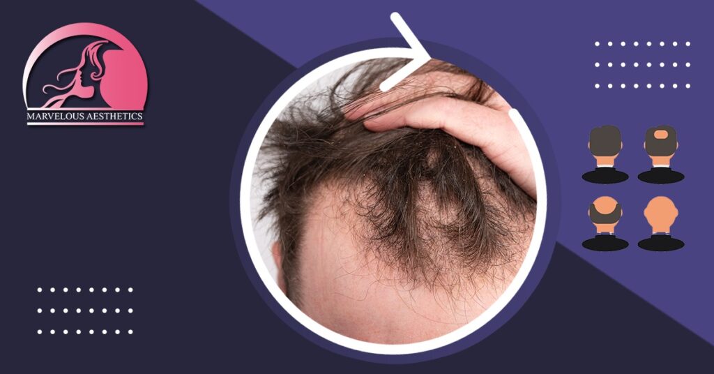 Can Hereditary Hair Loss Be Prevented?